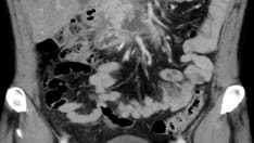 Three Days of Abdominal Pain in a Man With Alcohol Abuse