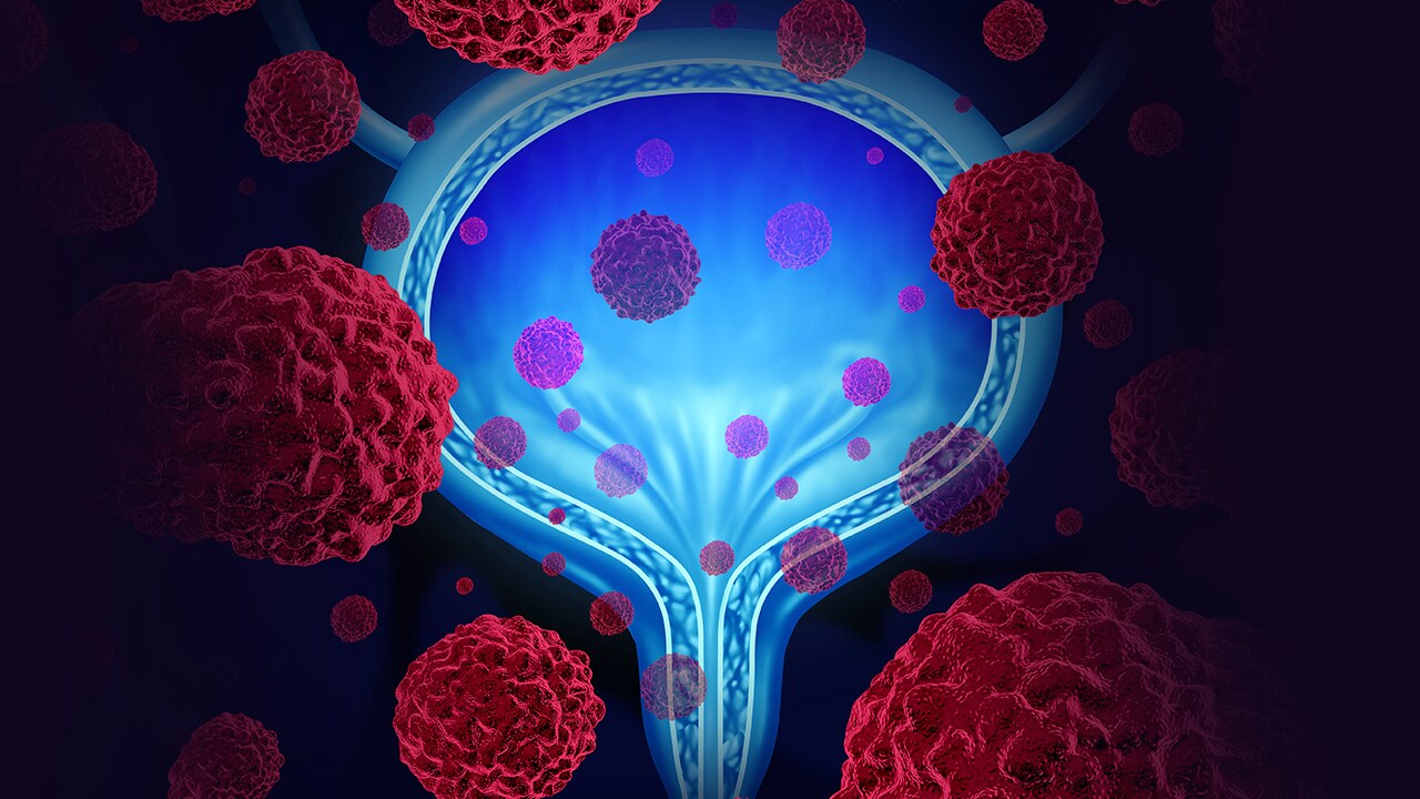 Os avanços mais recentes em terapias direcionadas no carcinoma urotelial avançado/metastático: Evidências e implicações  