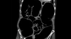 Ogilvie Syndrome (Acute Colonic Pseudo-obstruction): Early Recognition and Treatment Are Key