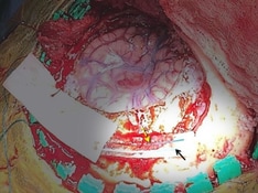 Lesiones cerebrales: resúmenes de 10 casos