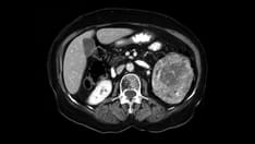 Don't Miss the Dx: A 61-Year-Old Man With Left Flank Pain, Fever, Night Sweats, and Malaise