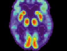 Alzheimer's Disease Increasing Numbers, But No Cure