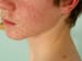 Teen Acne Tied to Prostate Cancer Risk