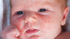 neonatal acne african american