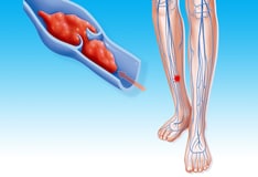 Antithrombin III Deficiency Workup: Laboratory Studies, Imaging Studies ...