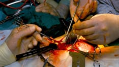 US Kidney Transplants Grow in Number and Success