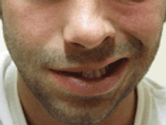 Facing the Truth About Bell Palsy