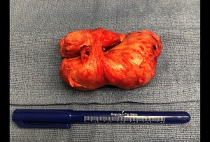Benign Prostatic Hyperplasia