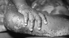 Case of Monkeypox Confirmed in Massachusetts