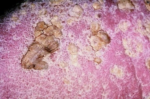 Poisoning on the Skin