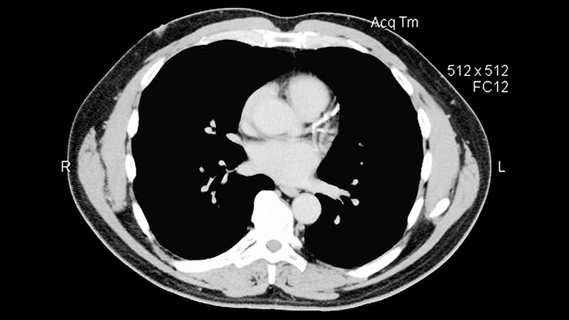 Playing the Long Game: Managing Cardiovascular Risk in Young Adults: The Case for CAC