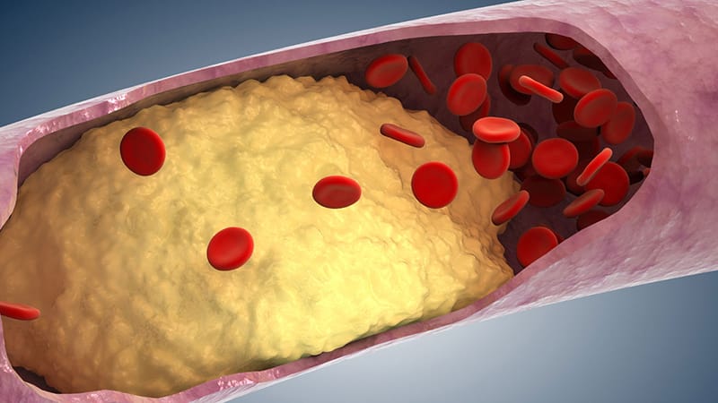 Cardiovascular Risk Reduction: Protecting the Aging Heart: Controlling Lipids