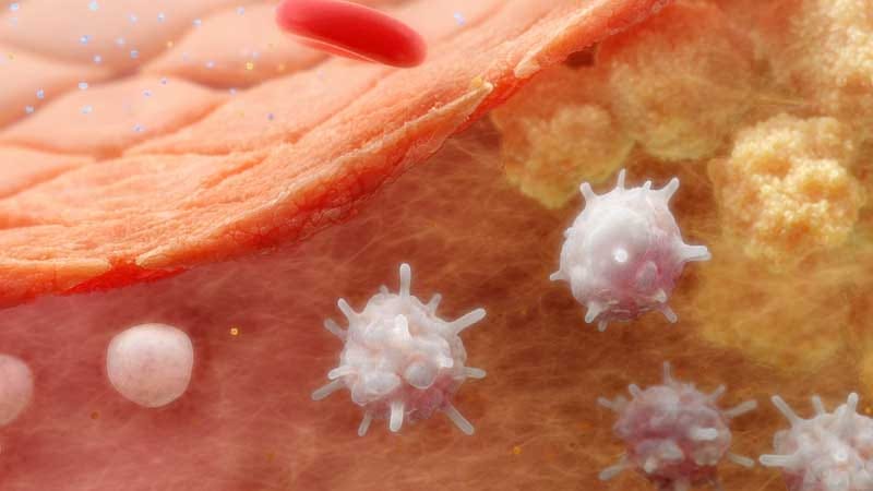 Beyond Glucose: Reducing CVD in Patients With Diabetes