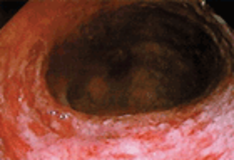 Proctitis and Anusitis: Background, Anatomy, Pathophysiology