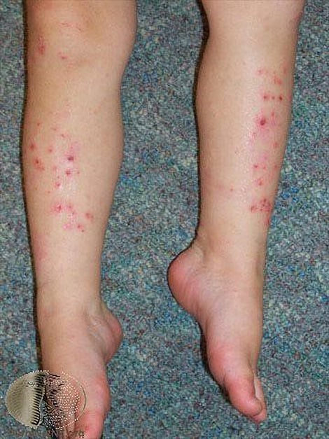 Common and Not-so-Common Rashes in Kids - Page 2