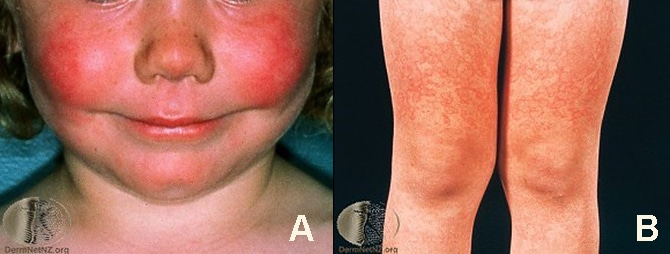 Common and Not-so-Common Rashes in Kids