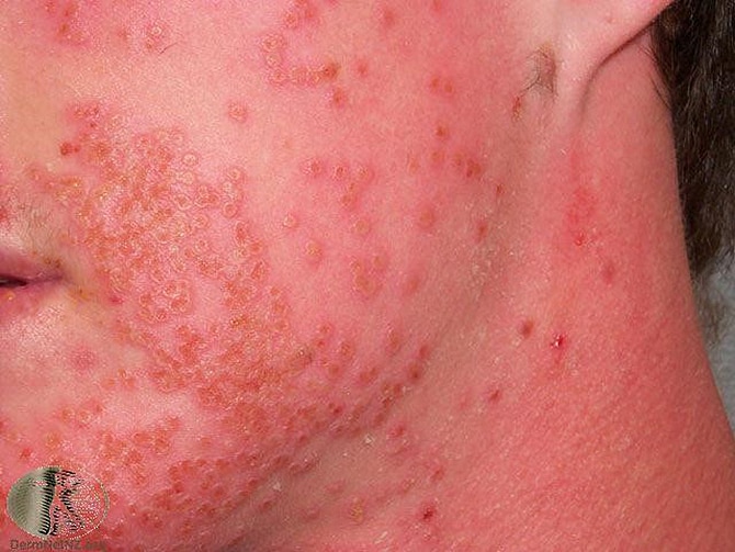 Common and Rashes in Kids Page 2