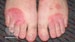 Two Biologics Evaluated for Facial, Hand, Foot Dermatitis