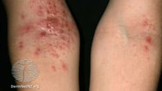 52-Week Data Show Lebrikizumab Atopic Dermatitis Effects Maintained