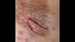 Hidradenitis Suppurativa: CO<sub>2</sub> Laser Therapy Shows No Keloid Risk