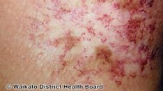 Bacterial Decolonization Prevents Acute Radiation Dermatitis
