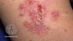 Study on KC Risk in Pediatric Transplant Recipients Points to Need for Education, More Research