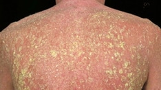 New Consensus Guide on Rare Drug Hypersensitivity Reaction