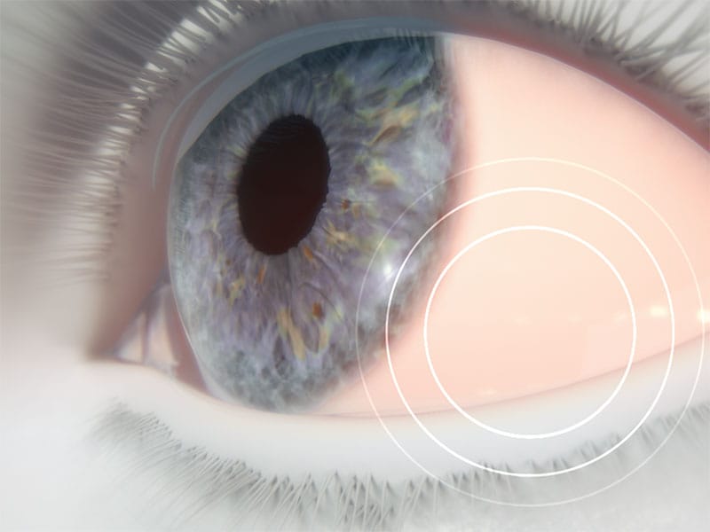 Dry Eye: Key Diagnostic Tools
