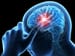 Small Brain Lesions Equal Big Stroke, Big Mortality Risk