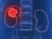Finally, Drug Improves Survival in Pretreated Kidney Cancer
