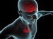 IRIS: Diabetes Drug Reduces Recurrent Stroke, MI