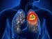 Durvalumab Boosts PFS Even in Stage 3 Lung Cancer