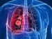 Pembrolizumab First-Line Beats Chemo: 'It's a New Day for Lung Cancer'