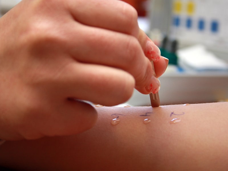 Как выглядит аллергия на пробу Special Report: When a Patient Reports a Penicillin Allergy, You Should.