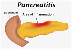 Chronic Pancreatitis: Practice Essentials, Background, Pathophysiology