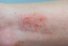 Pediatric Keratosis Pilaris: Background, Pathophysiology, Epidemiology