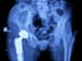 Persistent Opioid Use High After Hip or Knee Surgery