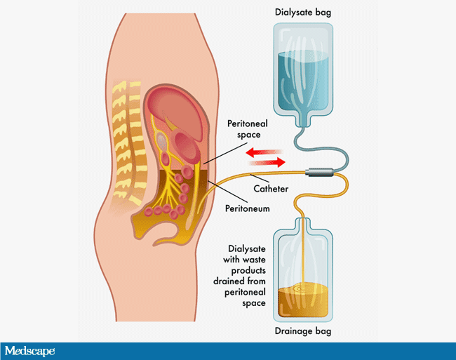 Initiating Peritoneal Dialysis After Catheter Insertion