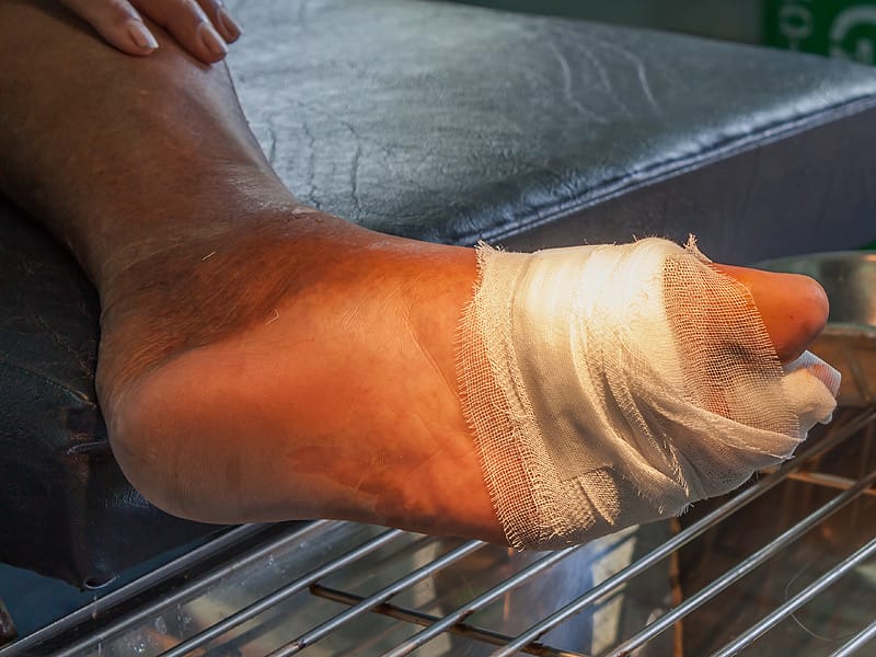 Dressing Hastens Neuroischemic Diabetic Foot Ulcer Healing