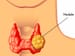 Thyroid Nodules: Bethesda System Update Changes Clinical Practice