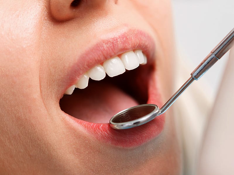 More Evidence Links Gum Disease to Stroke Risk  