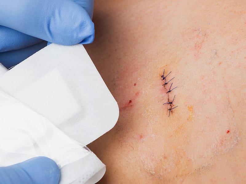 Experts Welcome Adjuvant Nivolumab for Melanoma