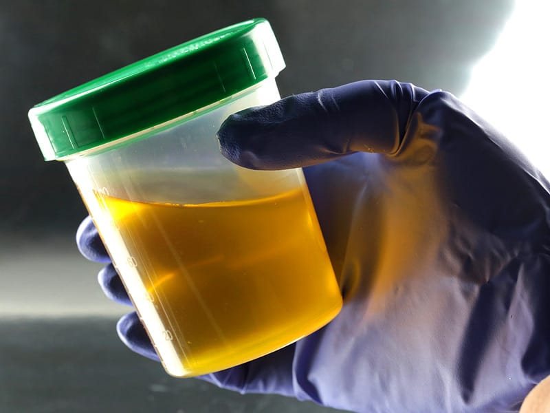 Urinalysis Accurately Pinpoints UTI in Febrile Infants