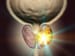 'Finally, Real Promise' for Prostate Cancers With No Therapy