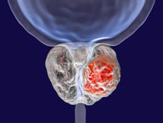 Institute of Cancer Research Criticises NICE Rejection of Abiraterone