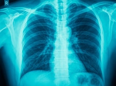 Simple Screening Test for COPD Could Reduce Global Burden of Undiagnosed Disease