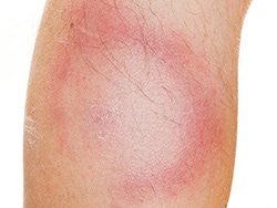 UK Guidelines Quiz: Lyme Disease