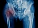 Osteoporosis Rx Rates Continue Downwards Trajectory