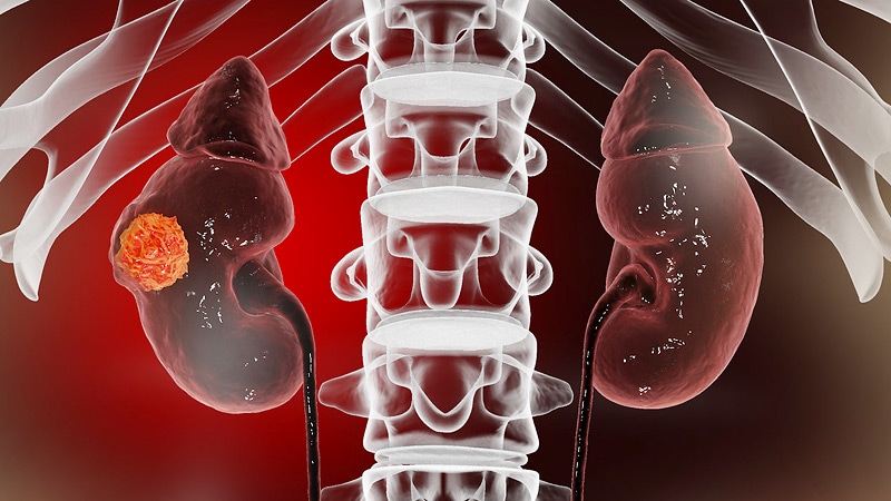 Renal Cell Carcinoma | Medscape