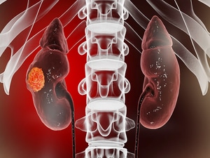 Urine Test Differentiates Kidney Cancer From Benign Lesions